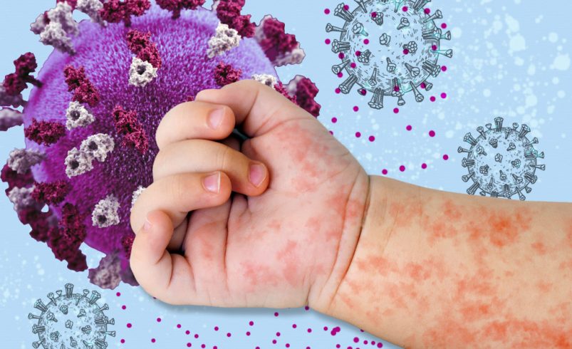 Aumento de sarampión en México ¿cómo contenerlo?