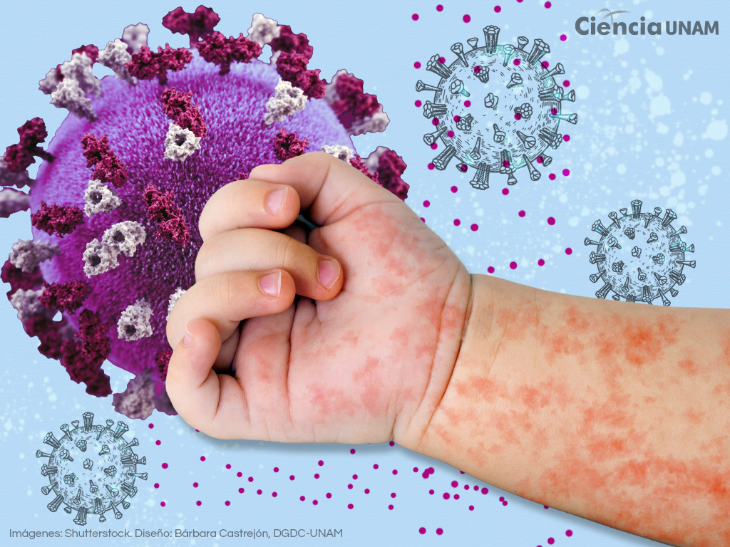 Aumento de sarampión en México ¿cómo contenerlo?