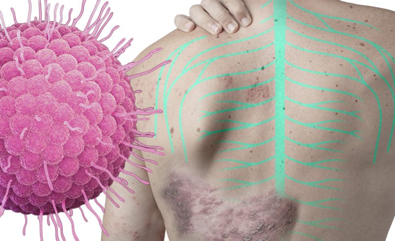 Herpes Zóster. El doloroso despertar del virus de la varicela