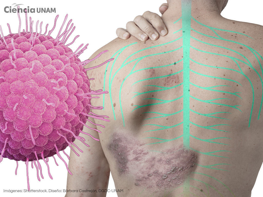 Herpes Zóster. El doloroso despertar del virus de la varicela